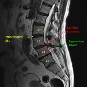 L L Bilateral Laminotomies Complete Orthopedics Ny