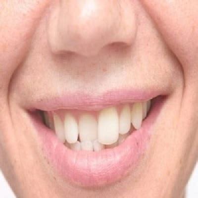 Crooked Teeth Treatment In Riyadh Saudi Arabia Crooked Teeth Cost