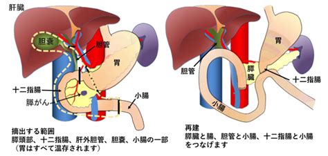 膵頭十二指腸切除術 Pancreaticoduodenectomy Japaneseclassjp