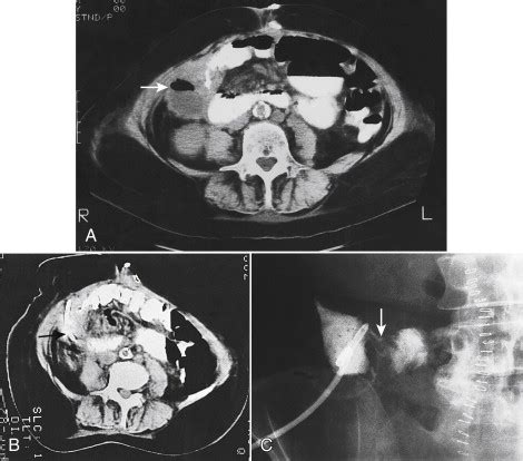 Percutaneous Abscess and Fluid Drainage - Clinical Tree