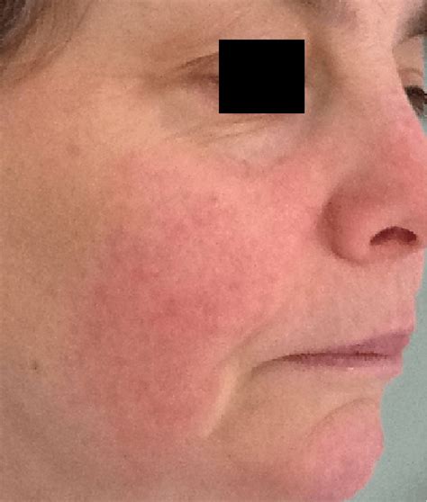 Mandelic Chemical Peel Treatment For Rosacea And Sensitive Skin