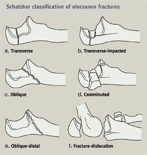 Fractures Of The Proximal Radius And Ulna Orthopaedics And Trauma