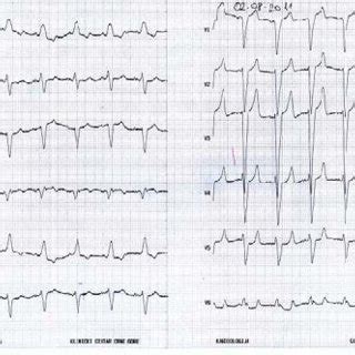 Electrocardiography Ecg On Admission Showed A Wide Left Bundle