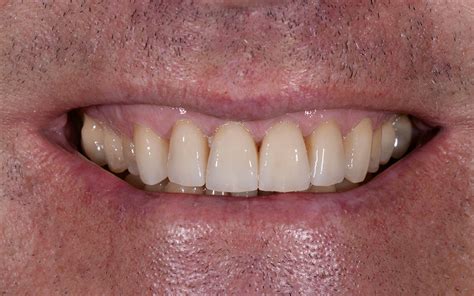 Dental Crowns Brisbane — Queensland Prosthodontics Dr Michael Brandon