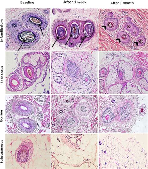 Normal Hair Follicle Histology