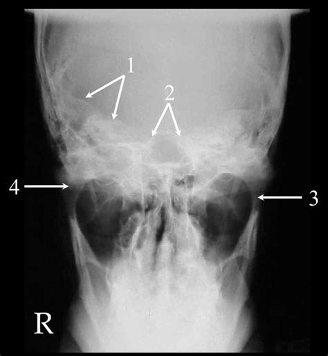 Towne S Mandible Diagram Quizlet