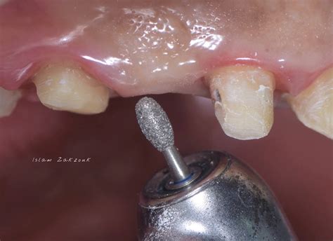 Ovate Pontic For The Correct Emergence Profile A Clinical Case