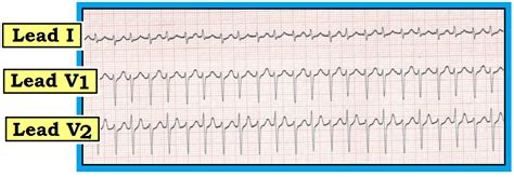 Ecg Interpretation Ecg Interpretation Review 83 Psvt Avnrt Avrt Alternans Electrical