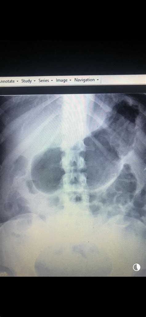 Abdominal X Rays Distended Stomach Xrays