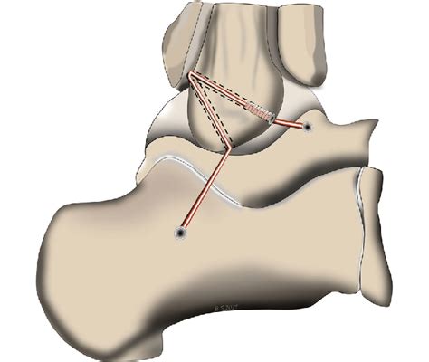 Anatomic lateral ankle ligament reconstruction technique. (1) The... | Download Scientific Diagram