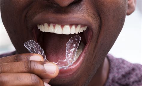 Invisalign Highgate Dental Practice