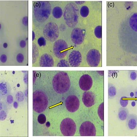 Image Of Micronucleus Test Of Human Peripheral Blood Lymphocytes