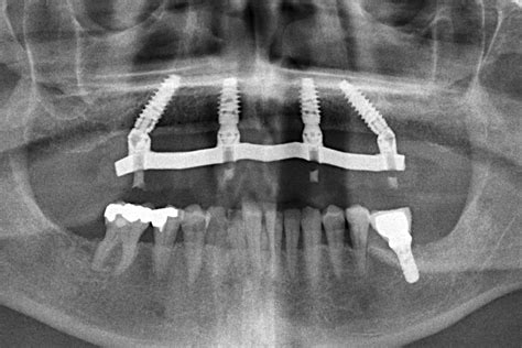 Assessing Your Surgeons Dexterous Skills And All On 4 Clinic