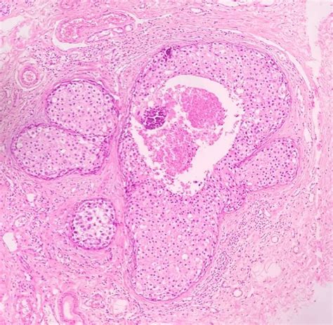 Histopathological Section Showing DCIS With Central Comedo Necrosis