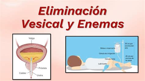 Eliminaci N Vesical Y Enemas Nataly Salda A Udocz