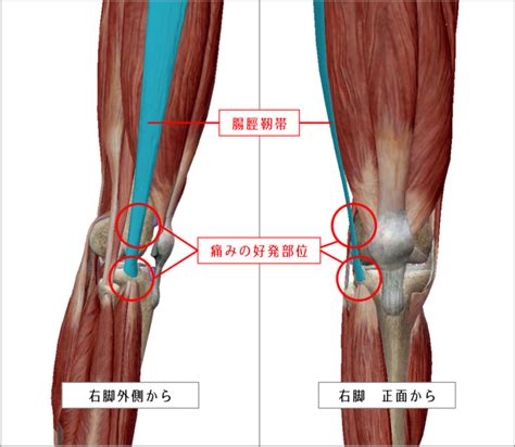 腸脛靭帯炎膝の外側の痛み別名ランナー膝 ひざの痛みでお悩みの方 スポーツ整体院めんてな