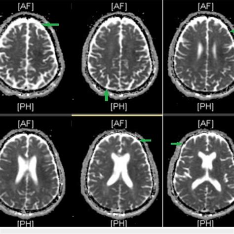 T2 Weighted Brain Mri Of A 70 Year Old Male With Neurosyphilis Showing