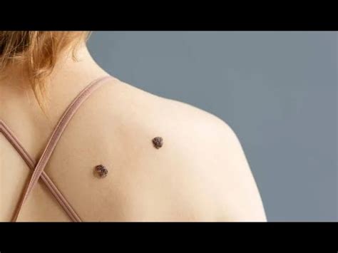 Como prevenir y tratar un melanoma Día mundial del melanoma YouTube