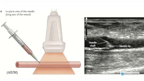 Instructional Series Sonon Needle Visualization Youtube