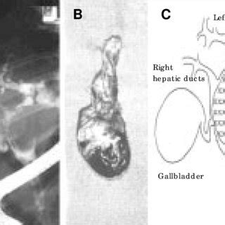 A Endoscopic Retrograde Cholangiography Shows A Smooth Oval Filling