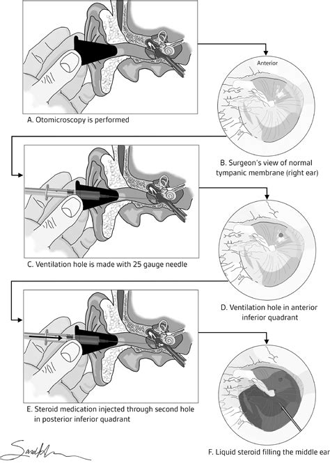 Intratympanic Steroid Injection Operative Techniques In Otolaryngology Head And Neck Surgery