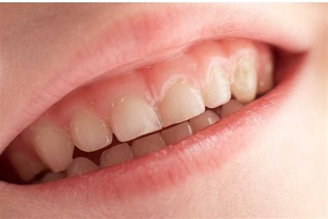 How To Remove Yellow Stains From Childs Teeth5 Easy Method