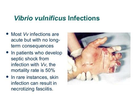 Vibrio vulnificus