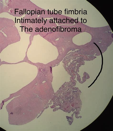 Fallopian Tube case 1 - THIS IS AN EXPERIMENT IN HAVING FUN WITH ...