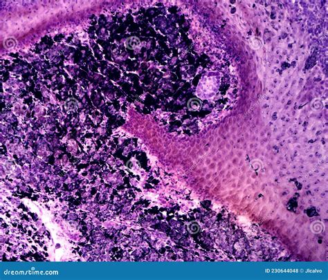 Intradermal Pigmented Nevus Stock Photo Image Of Cytological