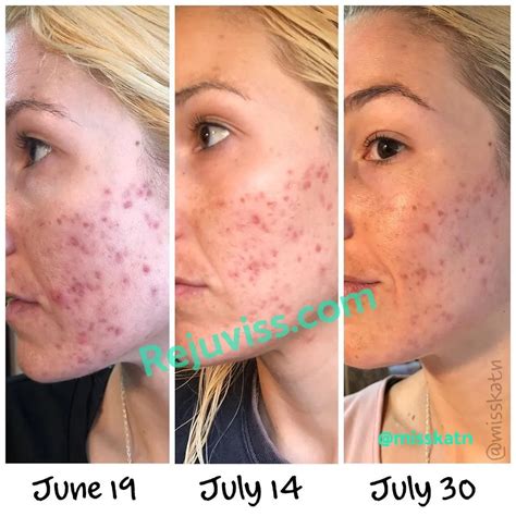 Dermarolling For Acne Scars Your Ultimate Guide Martlabpro