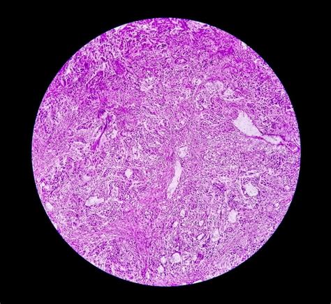 Premium Photo High Grade Transitional Cell Carcinoma Or Tcc A Bladder