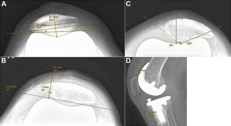 Influence Of Patellar Morphology Classified By Wiberg Classification On