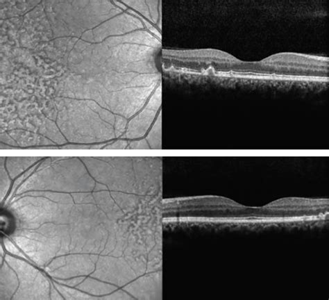 Case Report: Early-Onset Large Colloid Drusen - Retina Today