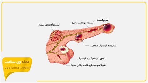سرطان پانکراس یا سرطان لوزالمعده را جدی بگیرید | وی سلامت