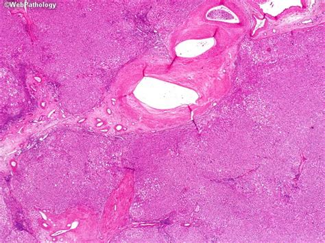 Focal Nodular Hyperplasia Microscopic