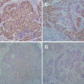 Bcl A Immunohistochemical Expression In Molecular Intrinsic Breast