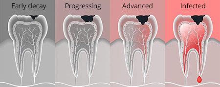 Tooth Decay Treatment in Bushwick, Brooklyn, NY | Dental Caries