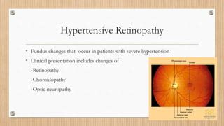 Hypertensive Retinopathy Ppt