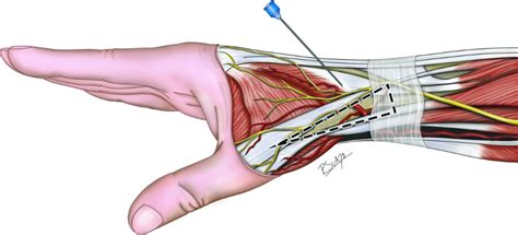 Distal Transradial Access In The Anatomical Snuffbox For Diagnostic