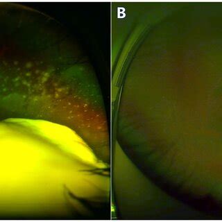 A Year Old Boy With Group D Retinoblastoma Presented With A Large