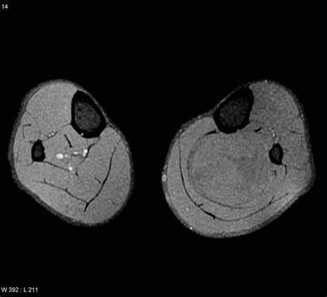 Tibial Nerve Schwannoma Image Radiopaedia Org