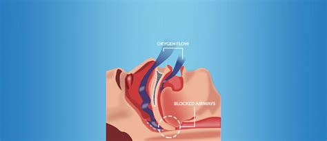 Snoring And Sleep Apnea Timbercrest Dental Center