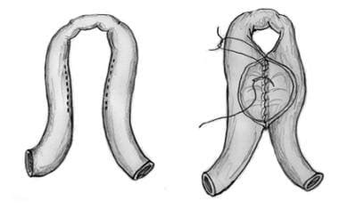 Strictureplasty Technique: Approach Considerations, Heineke-Mikulicz ...