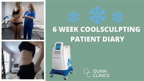 Coolsculpting What To Expect Freeze Fat Off Does Coolsculpting