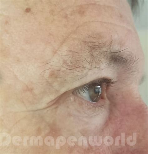 Dermapen Mediface Aesthetics Skin Care Doncaster