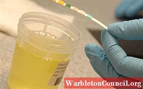 Cloudy Urine: Possible Causes and Treatments - science - 2024