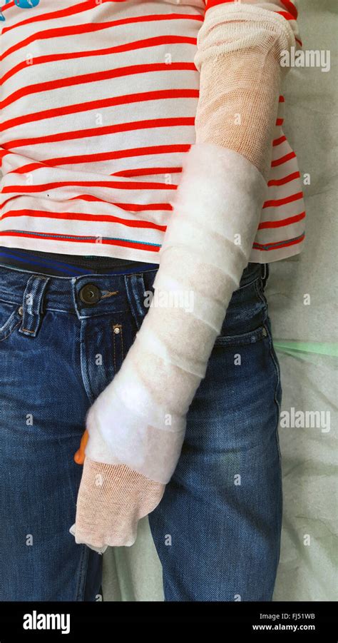 Distal Radius Fracture Hi Res Stock Photography And Images Alamy