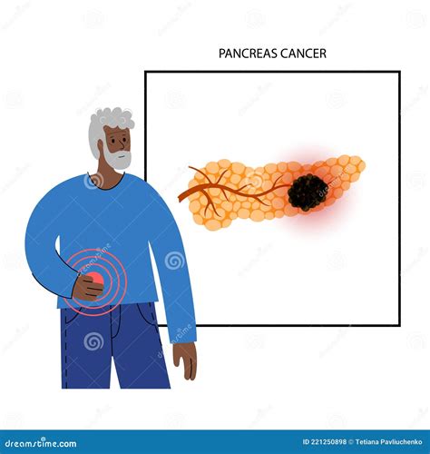 Pankreas Krankheit Und Krebs Vektor Abbildung Illustration Von Krebs
