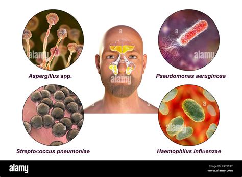 Rhinosinusitis And Microorganisms That Cause Sinusitis Fungi