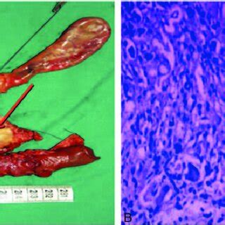 A Gross Appearance Of Resected Specimen The Lesion Located In The